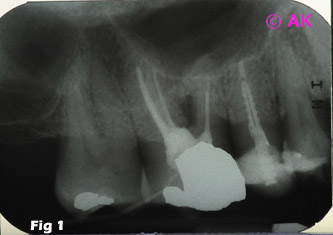 Case Studies | AK Endodontics | Dr. Anna Kim